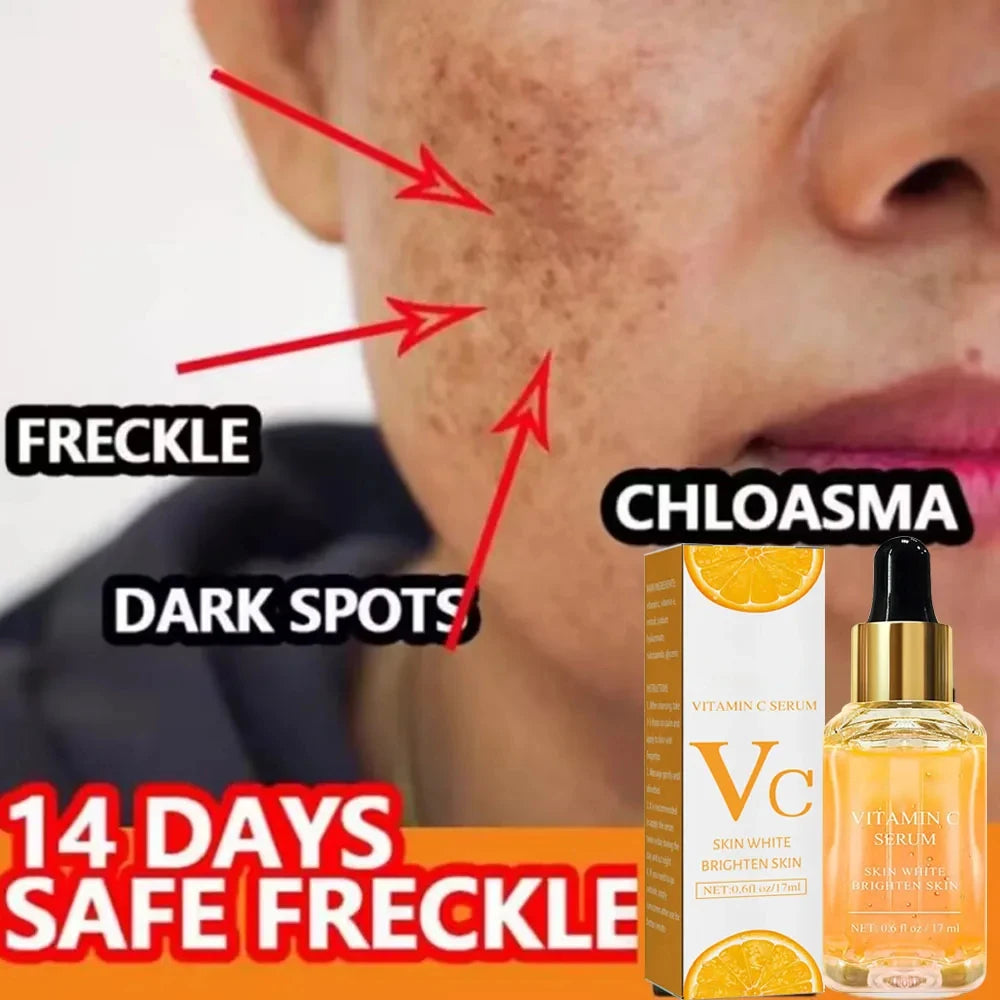 Vitamin C Whitening Serum: Dark Spot and Freckle Removal, Anti-Wrinkle Retinol Essence for Brightening - Korean Skincare